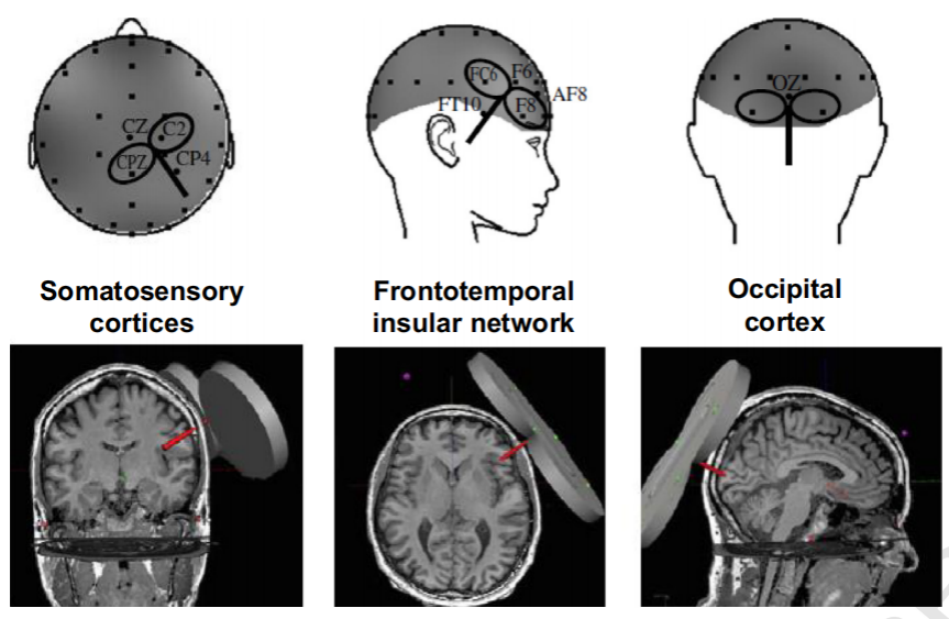 MRI,脑电,TMS